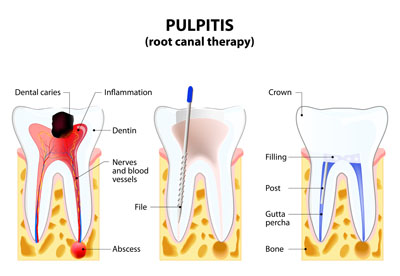 A Root Canal Dentist Can Save Your Tooth