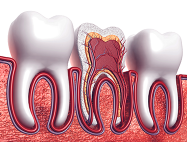 Root Canals