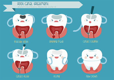 What to Expect During an Emergency Root Canal