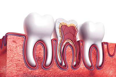 Root Canal